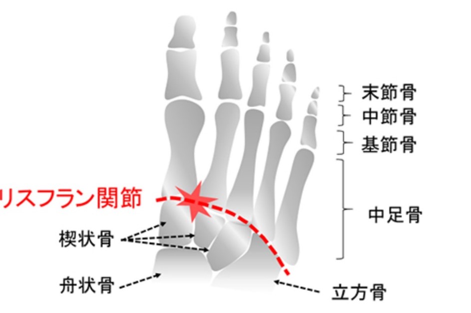 足のリスフラン関節の脱臼について書いたイラスト